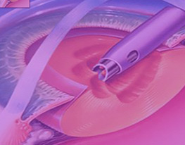 Keratoplasty Training